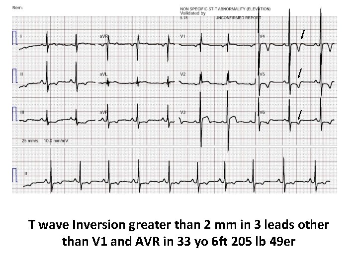 T wave Inversion greater than 2 mm in 3 leads other than V 1