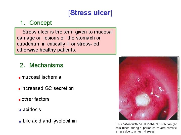 [Stress ulcer] 1．Concept Stress ulcer is the term given to mucosal damage or lesions