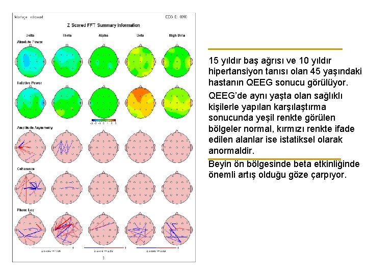 15 yıldır baş ağrısı ve 10 yıldır hipertansiyon tanısı olan 45 yaşındaki hastanın QEEG