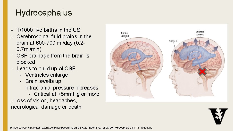 Hydrocephalus - 1/1000 live births in the US - Cerebrospinal fluid drains in the