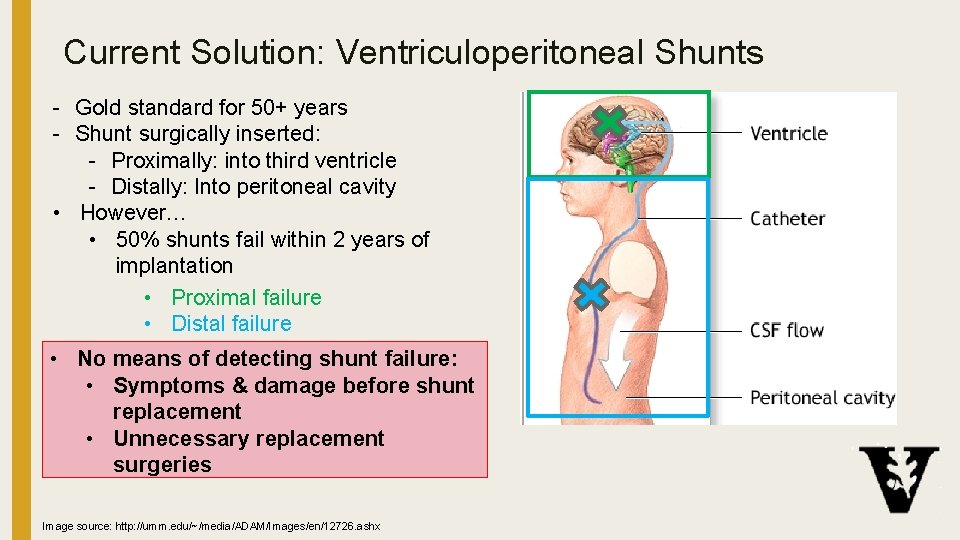 Current Solution: Ventriculoperitoneal Shunts - Gold standard for 50+ years - Shunt surgically inserted: