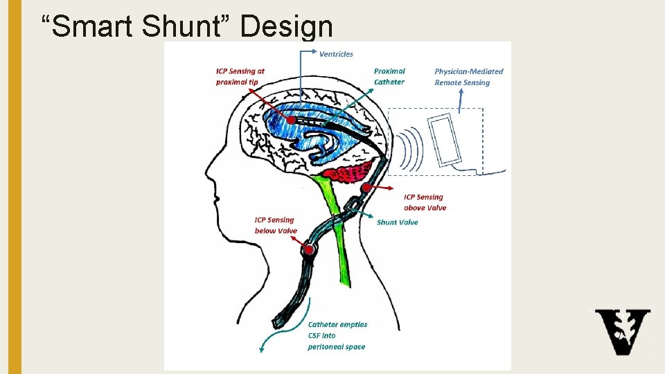 “Smart Shunt” Design 