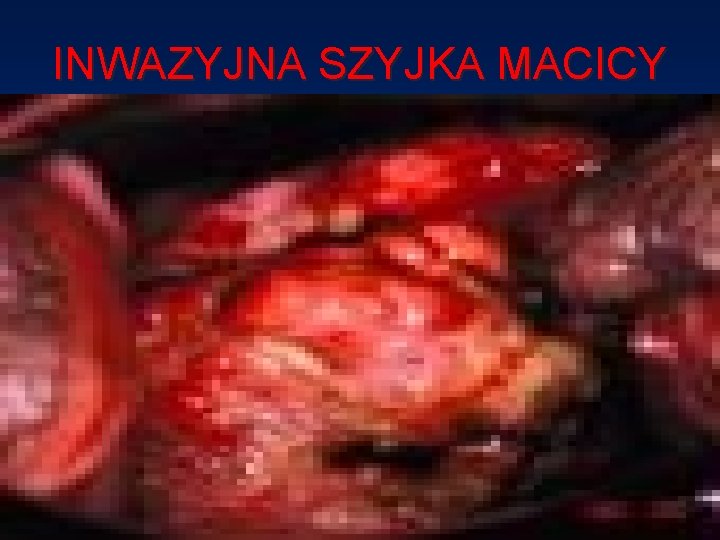 INWAZYJNA SZYJKA MACICY 