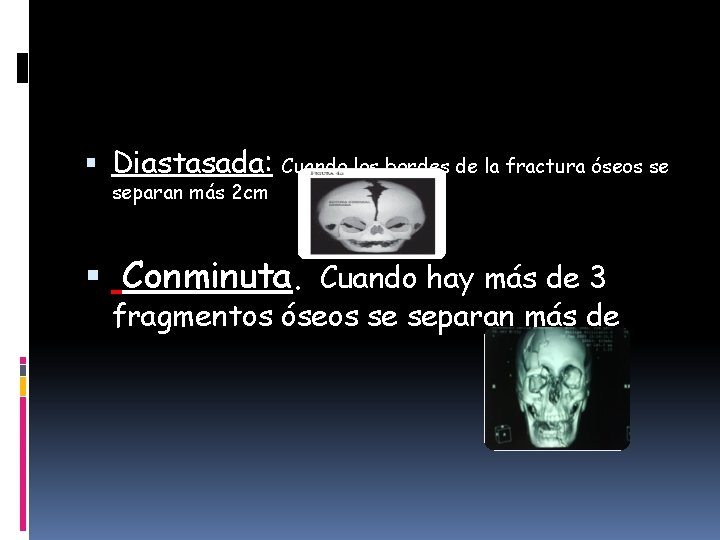  Diastasada: separan más 2 cm Cuando los bordes de la fractura óseos se