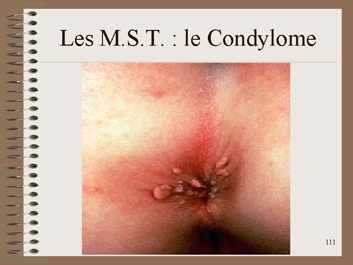 Les M. S. T. : le Condylome 111 