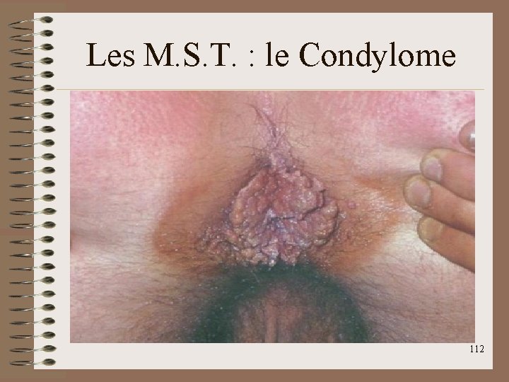 Les M. S. T. : le Condylome 112 