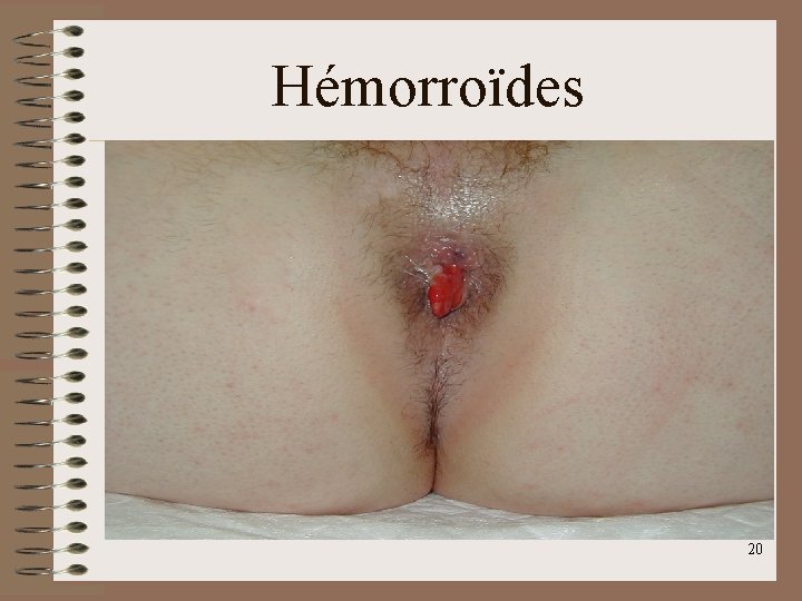 Hémorroïdes 20 