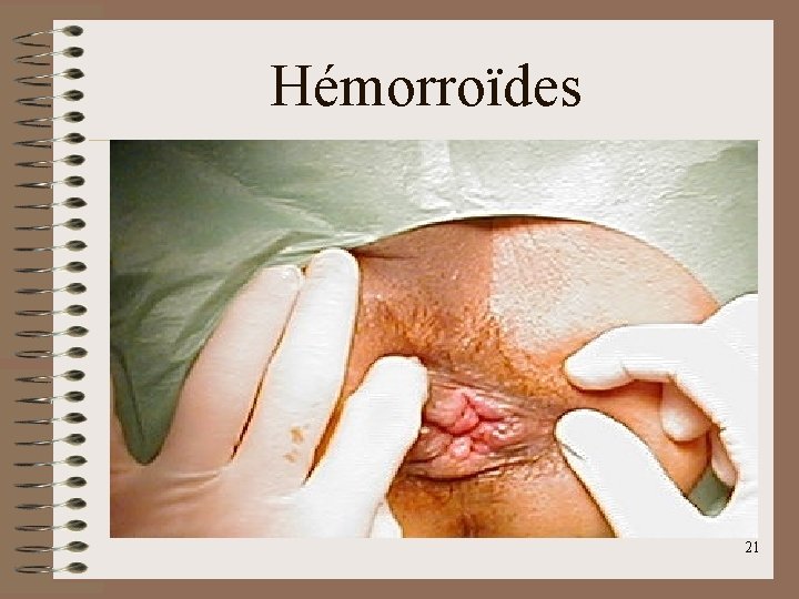 Hémorroïdes 21 