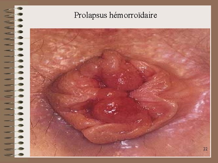 Prolapsus hémorroïdaire 22 