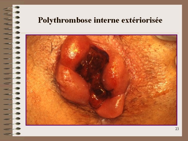 Polythrombose interne extériorisée 23 