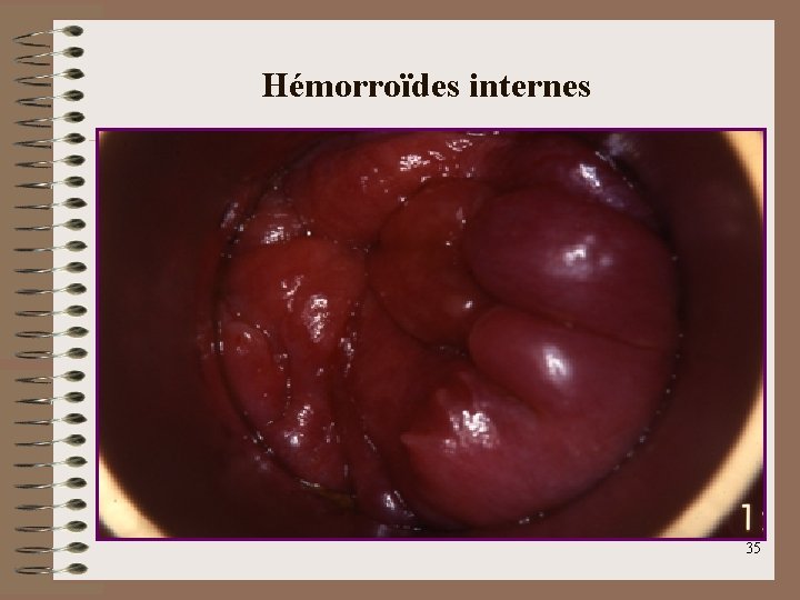 Hémorroïdes internes 35 