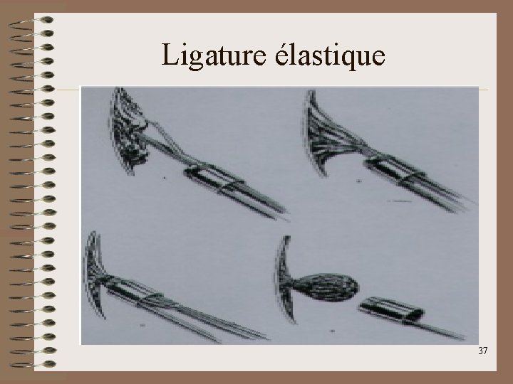 Ligature élastique 37 