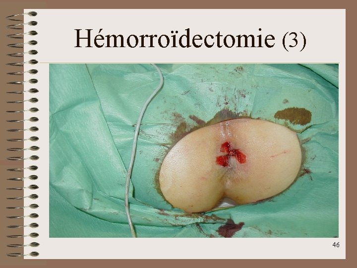 Hémorroïdectomie (3) 46 