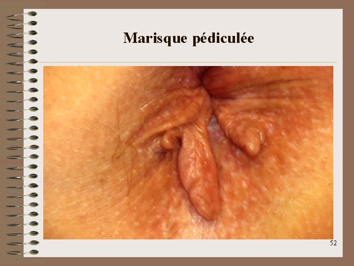 Marisque pédiculée 52 