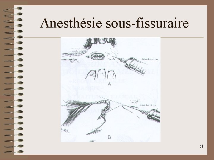 Anesthésie sous-fissuraire 61 