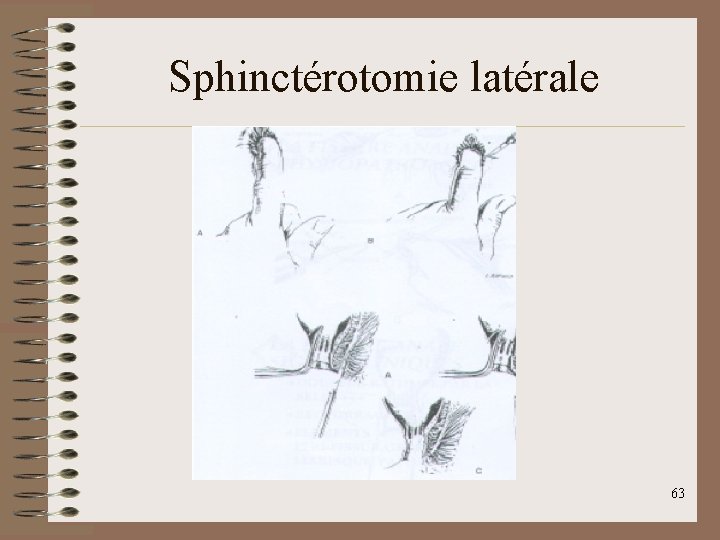 Sphinctérotomie latérale 63 