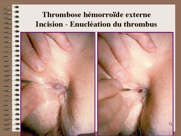 Thrombose hémorroïde externe Incision - Enucléation du thrombus 72 