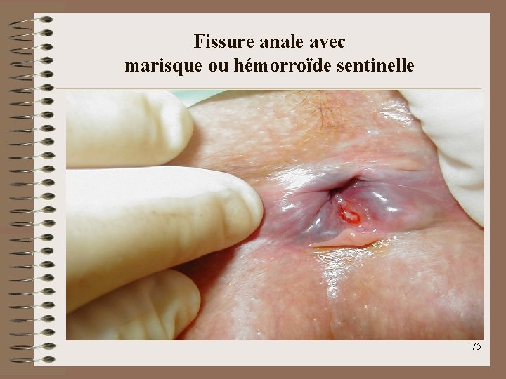 Fissure anale avec marisque ou hémorroïde sentinelle 75 