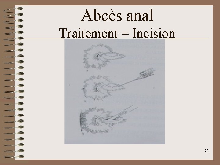 Abcès anal Traitement = Incision 82 