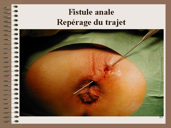 Fistule anale Repérage du trajet 83 