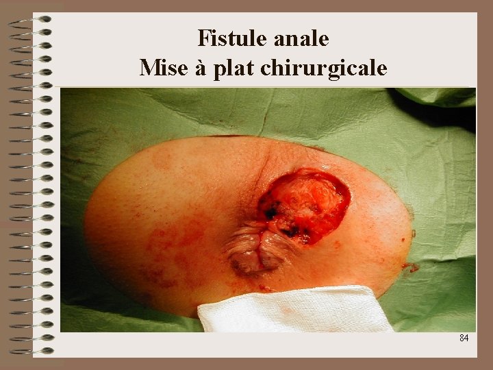 Fistule anale Mise à plat chirurgicale 84 