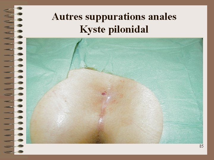 Autres suppurations anales Kyste pilonidal 85 