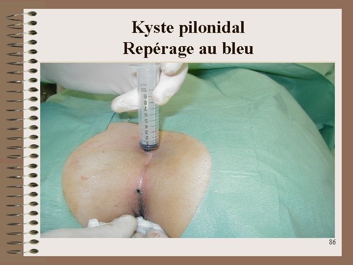 Kyste pilonidal Repérage au bleu 86 