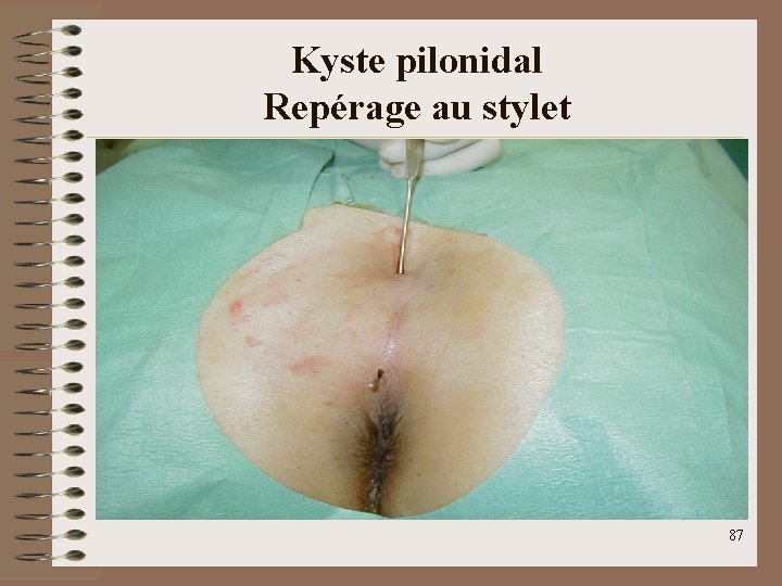 Kyste pilonidal Repérage au stylet 87 