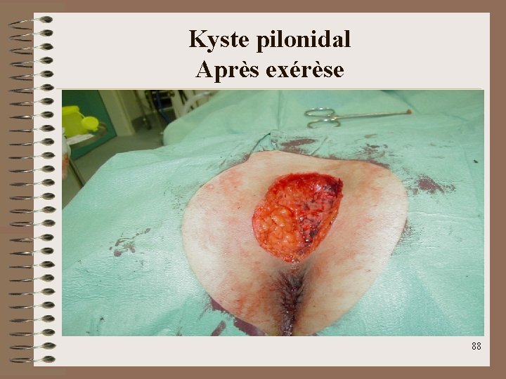 Kyste pilonidal Après exérèse 88 