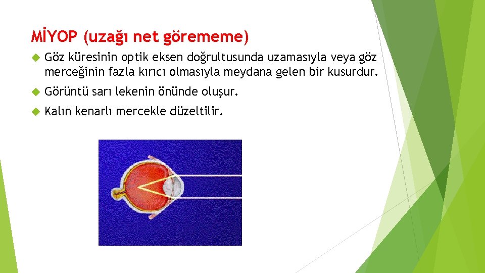 MİYOP (uzağı net görememe) Göz küresinin optik eksen doğrultusunda uzamasıyla veya göz merceğinin fazla