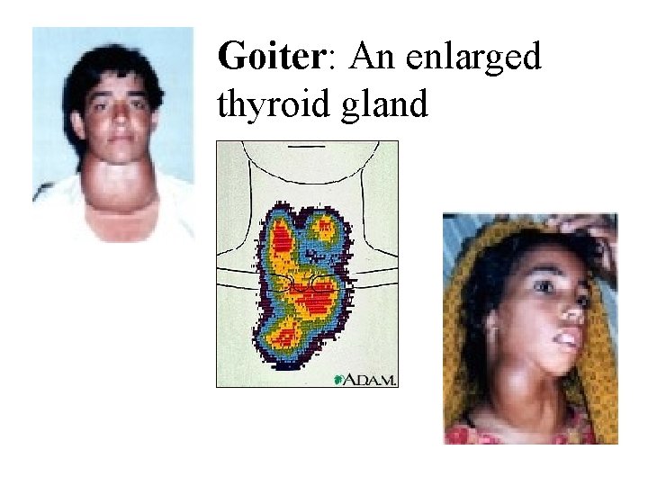 Goiter: An enlarged thyroid gland 
