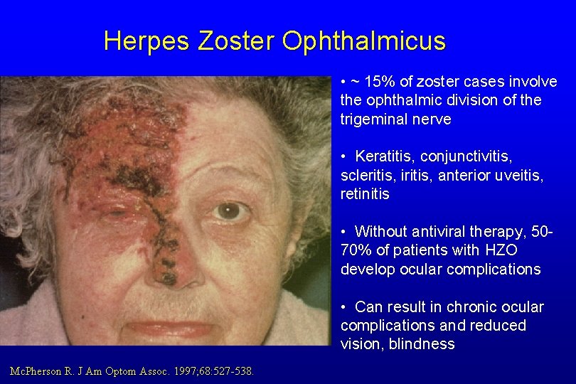 Herpes Zoster Ophthalmicus • ~ 15% of zoster cases involve the ophthalmic division of