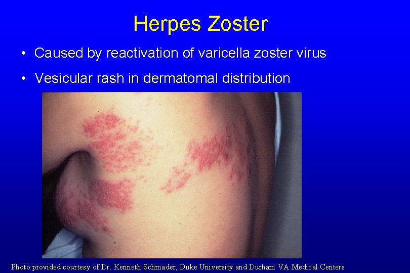 Herpes Zoster • Caused by reactivation of varicella zoster virus • Vesicular rash in