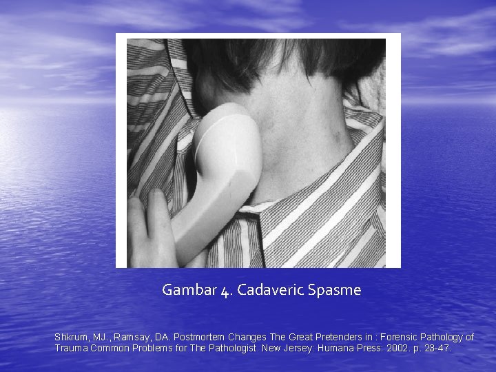 Gambar 4. Cadaveric Spasme Shkrum, MJ. , Ramsay, DA. Postmortem Changes The Great Pretenders