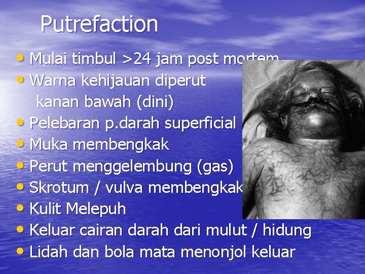 Putrefaction • Mulai timbul >24 jam post mortem • Warna kehijauan diperut kanan bawah