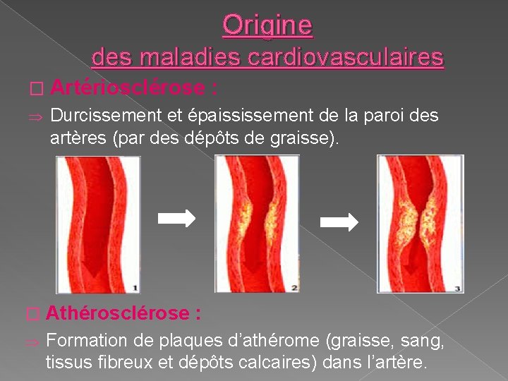 Origine des maladies cardiovasculaires � Artériosclérose : Þ Durcissement et épaississement de la paroi