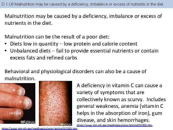 D. 1. U 6 Malnutrition may be caused by a deficiency, imbalance or excess