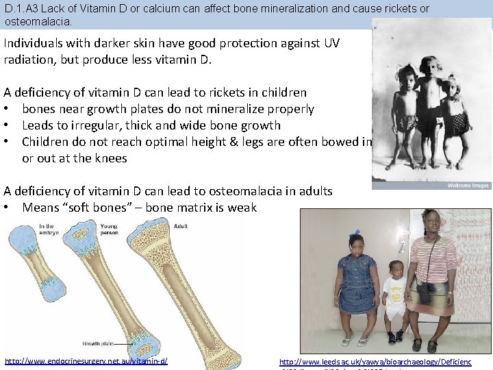 D. 1. A 3 Lack of Vitamin D or calcium can affect bone mineralization