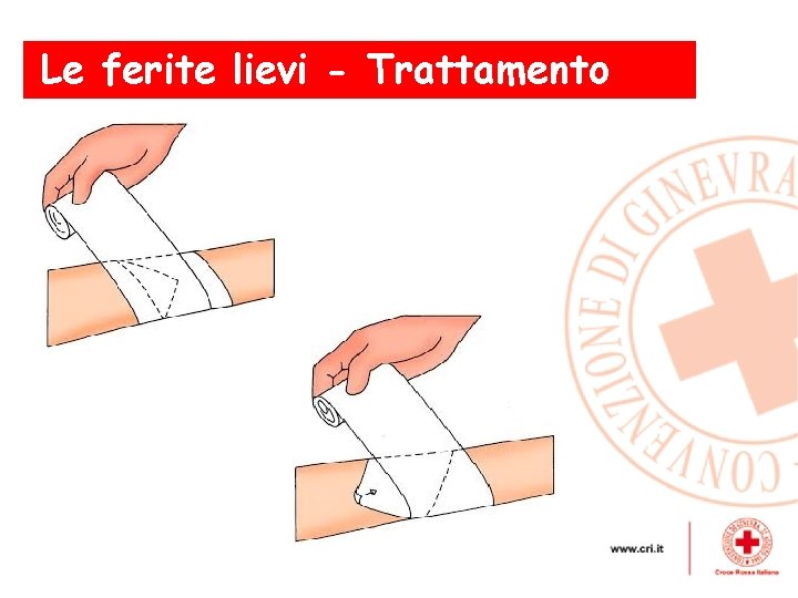 Le ferite lievi - Trattamento 