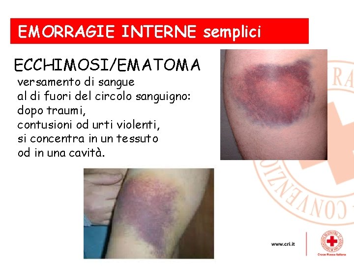 EMORRAGIE INTERNE semplici ECCHIMOSI/EMATOMA versamento di sangue al di fuori del circolo sanguigno: dopo