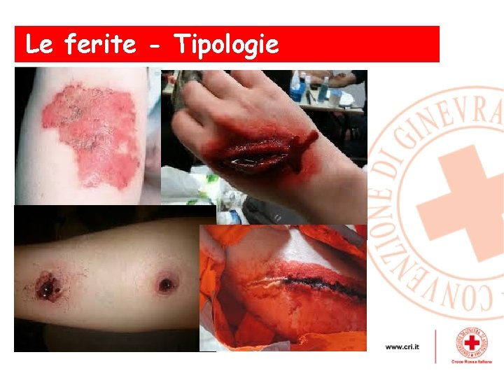 Le ferite - Tipologie , 