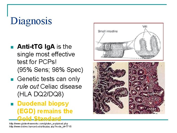 Diagnosis n n n Anti-t. TG Ig. A is the single most effective test Diagnosis n n n Anti-t. TG Ig. A is the single most effective test