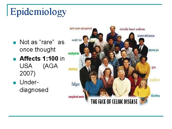 Epidemiology n n n Not as “rare” as once thought Affects 1: 100 in Epidemiology n n n Not as “rare” as once thought Affects 1: 100 in