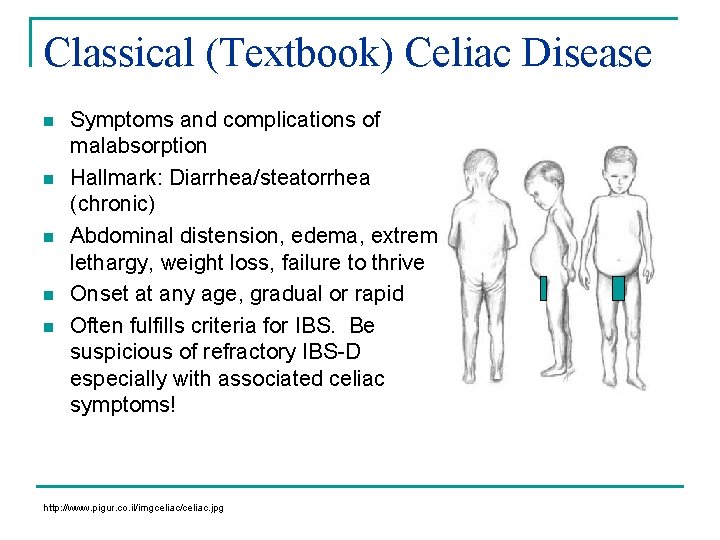 Classical (Textbook) Celiac Disease n n n Symptoms and complications of malabsorption Hallmark: Diarrhea/steatorrhea Classical (Textbook) Celiac Disease n n n Symptoms and complications of malabsorption Hallmark: Diarrhea/steatorrhea