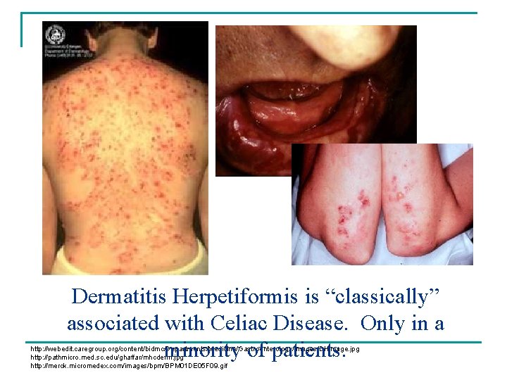 Dermatitis Herpetiformis is “classically” associated with Celiac Disease. Only in a minority of patients. Dermatitis Herpetiformis is “classically” associated with Celiac Disease. Only in a minority of patients.