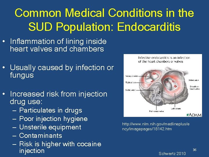 Common Medical Conditions in the SUD Population: Endocarditis • Inflammation of lining inside heart