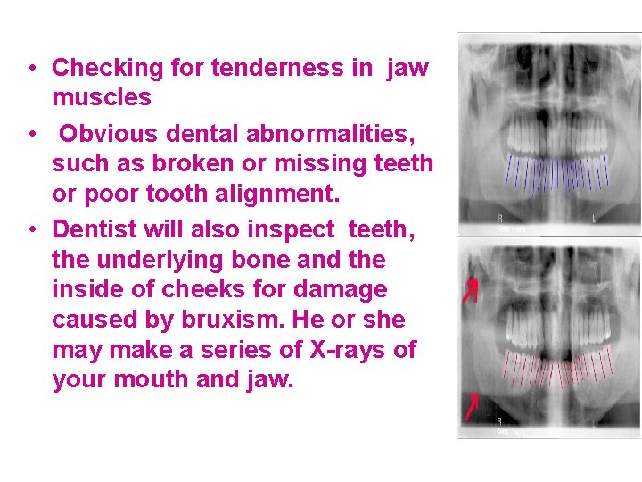  • Checking for tenderness in jaw muscles • Obvious dental abnormalities, such as