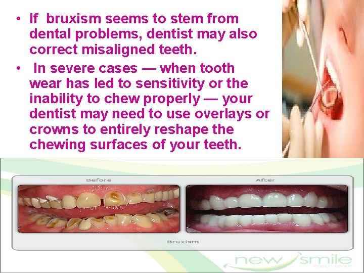  • If bruxism seems to stem from dental problems, dentist may also correct