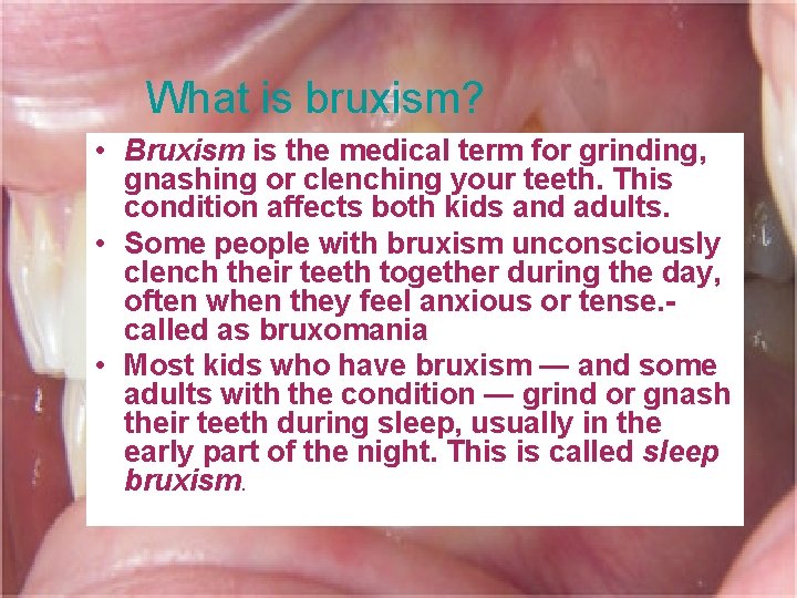 What is bruxism? • Bruxism is the medical term for grinding, gnashing or clenching