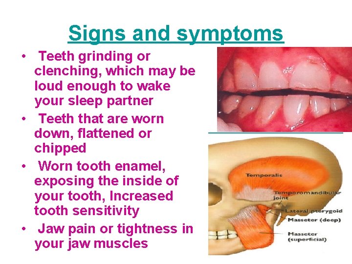 Signs and symptoms • Teeth grinding or clenching, which may be loud enough to